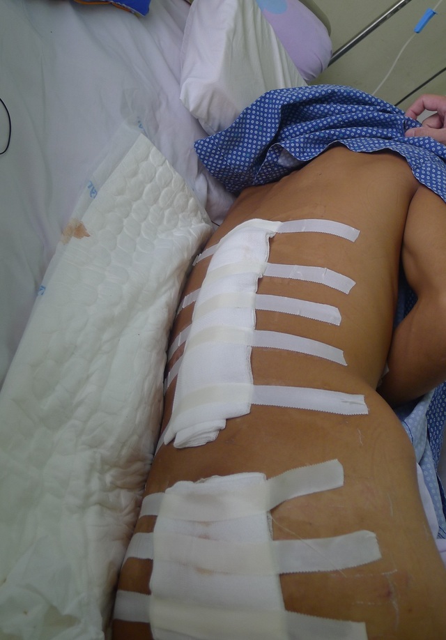 Đi làm thuê lấy tiền chữa bệnh cho mẹ, cậu bé dân tộc Dao bị tường đè dập phổi - 2 Em bị đa chấn thương, nguy kịch tính mạng.