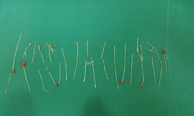 Mũi nữ diễn viên thủng nhiều lỗ sau 2 tháng cấy chỉ nâng mũi - 1 Số cọng chỉ bác sĩ lấy ra từ mũi nữ diễn viên