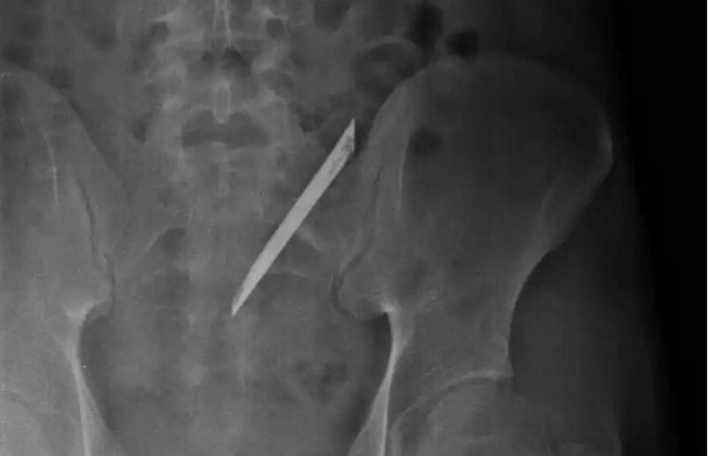 Lấy lưỡi dao 12 cm nằm 4 năm ở lưng nam thanh niên - 1 Lưỡi dao dài 12 cm qua hình chụp CT scan