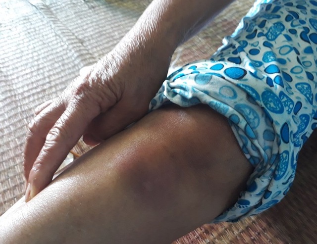2 phụ nữ bị đánh vì nghi bắt cóc: Họ quá hung hãn! - 2 Nhiều vùng trên cơ thể như đầu gối, mắt cá chân, hông, bả vai,... cũng bị đánh rất đau. Ảnh: TUYẾN PHAN