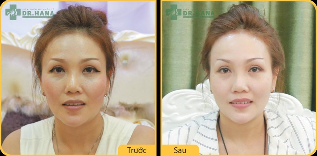 Bật mí phương pháp thách thức lão hóa, chinh phục phái đẹp trong nước và quốc tế - 2 Hình ảnh trước và sau khi căng da mặt của Việt Kiều Mỹ Hoàn Thy