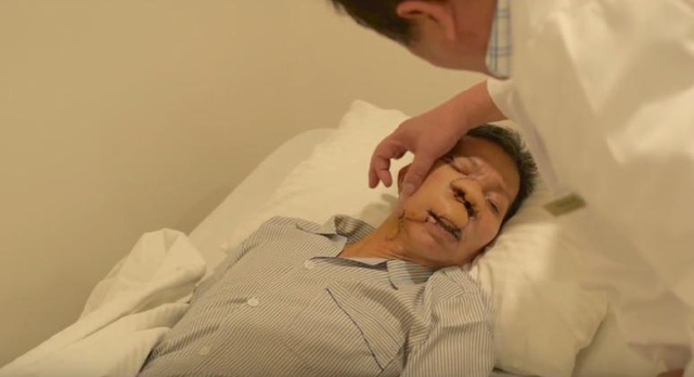 ‘Phép màu’ trả lại gương mặt cho người 10 năm bị ung thư da - 3 5 ngày sau mổ, ông Sứ đã hồi phục sức khỏe, khối u được loại bỏ, phần tạo hình tiến triển tốt