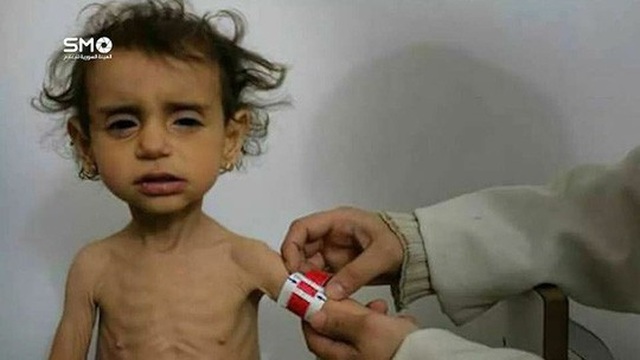 Cạn lương thực, người dân Syria phải "lục thùng rác" - 4
Bé gái 2 tuổi bị suy dinh dưỡng ở Ghouta. Ảnh: Twitter