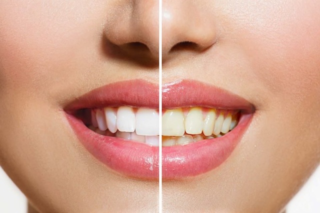 Răng vàng có tốt cho sức khỏe không?