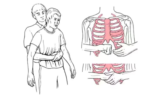 Nghiệm pháp Heimlich truyền thống