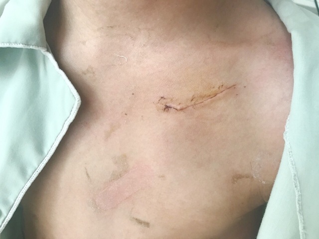 Cháu bé bị hội chứng Brugada dễ đột tử ban đêm được cấy máy đem lại sự sống - 2 Vết mổ khô sau 1 tuần cấy máy, không thấy lộ máy đảm bảo thẩm mỹ và giảm nguy cơ nhiễm trùng lộ máy