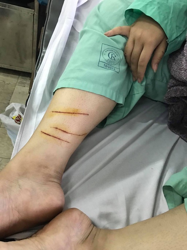 Kinh hoàng hơn 20 thanh niên truy sát thiếu nữ trong quán trà sữa - 2 Em Tr. với những vết thương do nhóm của H. gây ra