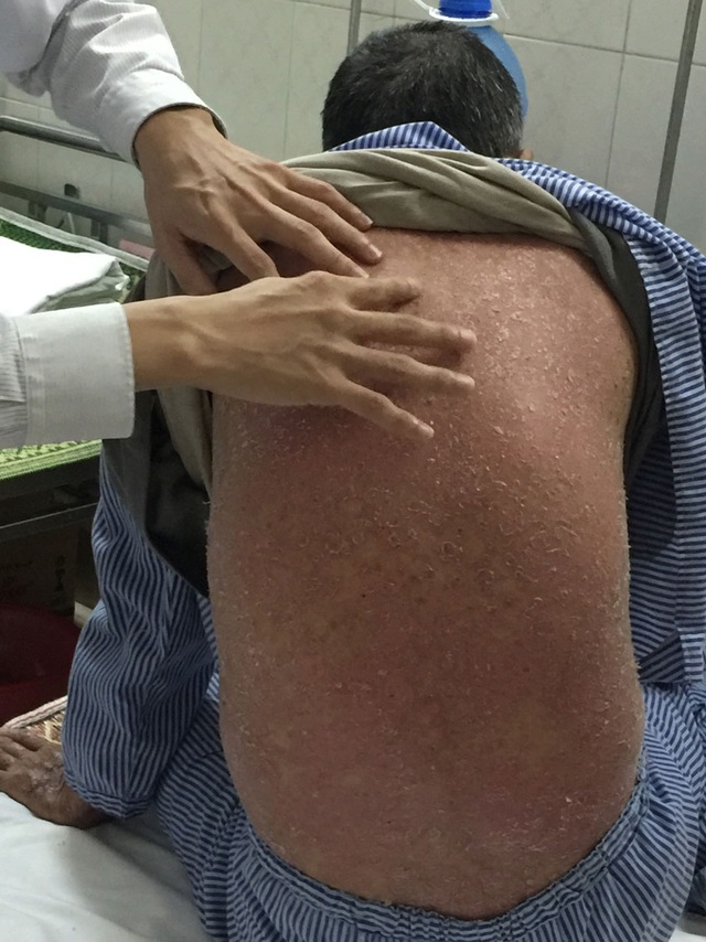 5 thách thức hàng triệu người mắc vảy nến đang phải đối mặt - 1
Bệnh nhân bị sốt, bong tróc da toàn thân sau khi uống 6 thìa thuốc đông y (Ảnh: T.P)