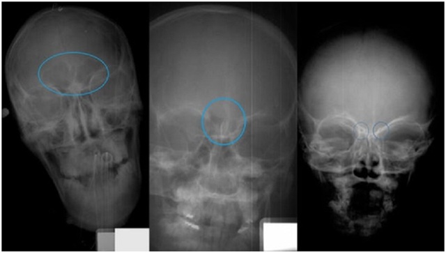 Phương pháp chụp X-quang xoang trán tiết lộ số tuổi của trẻ | Báo ...