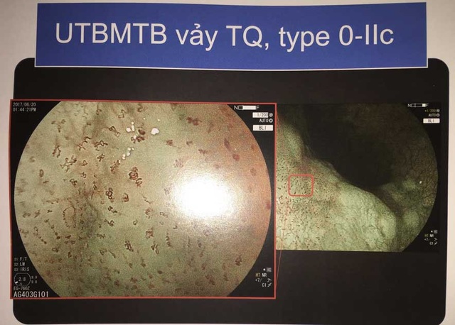 Ung thư thực quản: Có thể chẩn đoán sớm đến mức nào? - 3
Mạch máu dị dạng của khối ung thư thực quản