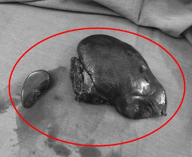 Nạn nhân bị đứt đôi gan sau va chạm giao thông - 1 Gan trái của bệnh nhân bị đứt gần lìa sau tai nạn, buộc phải cắt bỏ