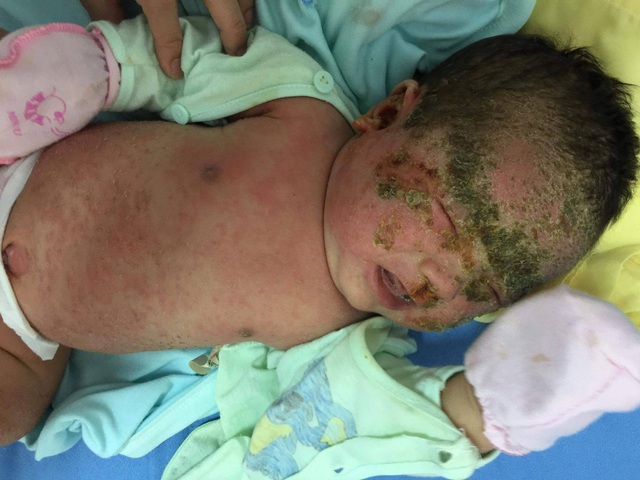 Bé sơ sinh 1 tháng tuổi chảy mủ toàn thân vì tắm lá - 1 Bé bị loét, lở toàn thân, tổn thương da chảy mủ, đóng vảy vì tắm lá.