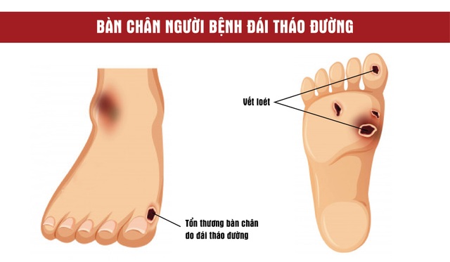 5 sai lầm khi chăm sóc bàn chân người tiểu đường mùa lạnh - 1 5 sai lầm khi chăm sóc bàn chân người tiểu đường mùa lạnh - 1