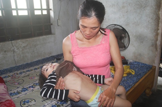 Bé Hải Yến bị dị tật bẩm sinh từ khi sinh ra.