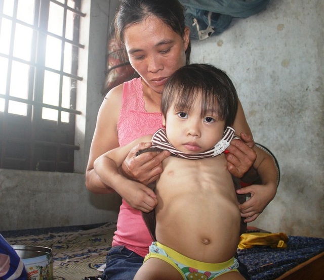 Thương bé gái 4 tuổi có nguy cơ bị bại liệt - 1 Phần bụng bé Hải Yến phình to, ngực lộ rõ xương.