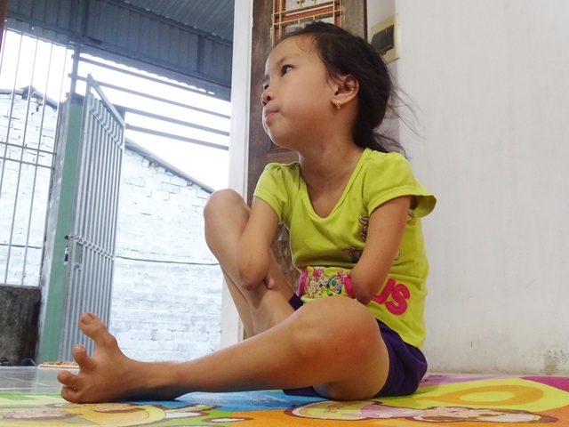 Cô bé 9 tuổi cụt hai tay, viết chữ đẹp như máy khiến bao người cảm phục - 1 Nguyễn Như Linh sinh ra đã kém may mắn hơn so với các bạn cùng trang lứa