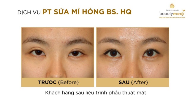 Càng gần cuối năm càng cần cẩn trọng với các dịch vụ phẫu thuật thẩm mỹ mắt giá rẻ - 5 Một số hình ảnh của khách hàng sau khi Phẫu thuật mắt với Bác sĩ Hàn Quốc tại Beauty Medi