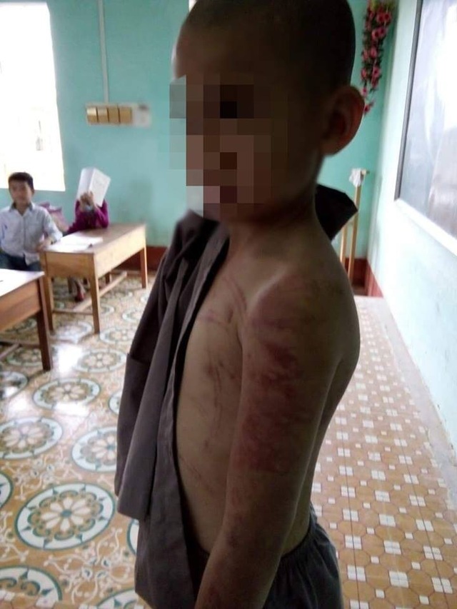 Cháu bé mồ côi bị sư thầy hành hạ: Đề nghị công an vào cuộc - 2 Hình ảnh cháu D. bị sư thầy dùng roi mây đánh thâm tím khắp cơ thể.