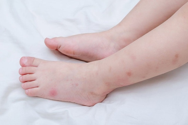 Ngăn ngừa sốt xuất huyết hiệu quả ngay tại nhà - Ảnh 1. Ngăn ngừa sốt xuất huyết hiệu quả ngay tại nhà - Ảnh 1.