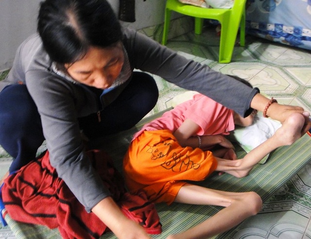 Chạnh lòng nhìn thiếu nữ xứ dừa chết mòn vì bại não - 3 Chân tay em Trâm co quắp nhìn thật xót xa.