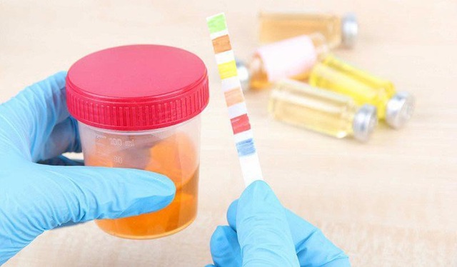 Đi tiểu ra máu, cẩn thận bạn đã mắc suy thận - 3 Nguy cơ suy thận cận kề nếu thấy máu trong nước tiểu