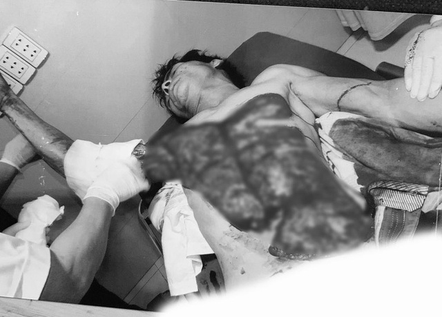 Kinh hoàng ngực, bụng bệnh nhân đỏ lòm vì bị máy bóc gỗ lột tung da - 1 Kinh hoàng ngực, bụng bệnh nhân đỏ lòm vì bị máy bóc gỗ lột tung da - 1