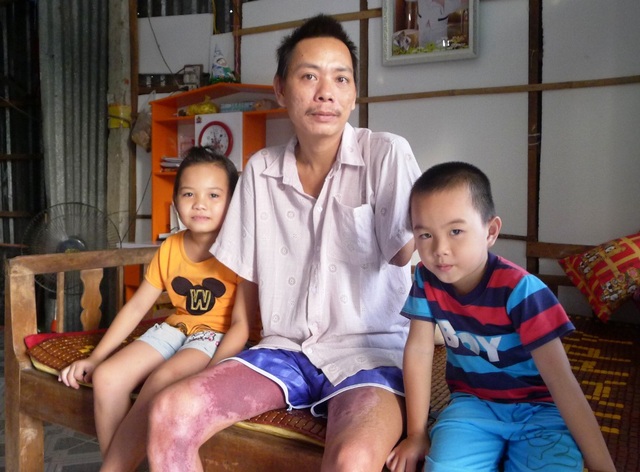 Trao hơn 42 triệu đồng đến “người đàn ông mất cả 2 tay vì điện giật” - 1 Nghe báo giá gắn hai cánh tay giả lên đến 200 triệu đồng, anh Vĩnh chẳng còn hy vọng mình gắn được hai tay giả để đi bán vé số nuôi hai con ăn học
