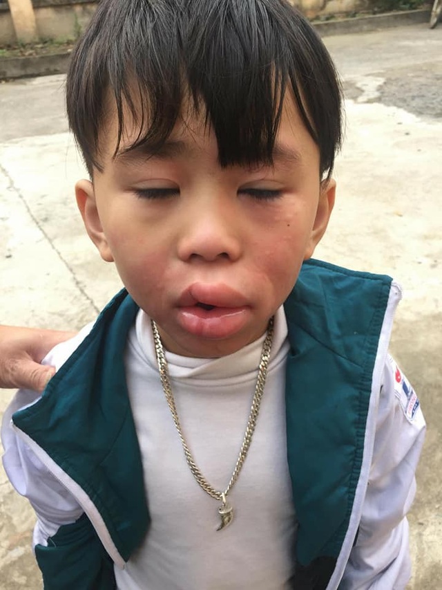 Một bé trai nghi bị ngộ độc sau khi ăn kẹo ở cổng trường | Báo Dân trí
