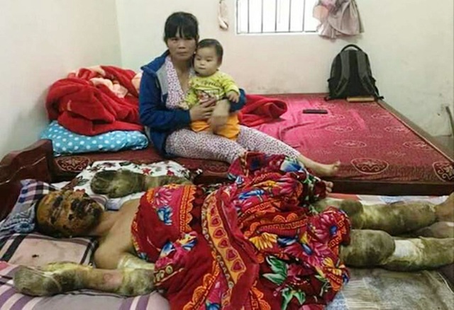 Đau đớn 2 phận người bỏng nặng nguy kịch trên giường bệnh - 4 Chị Sơn phải bế con nhỏ đi chăm sóc chồng tại bệnh viện.