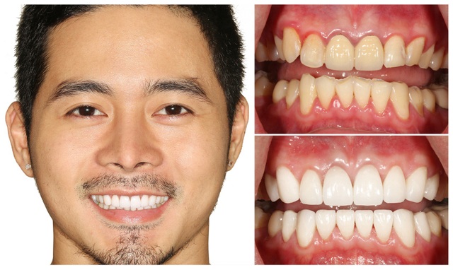 Đừng bọc răng sứ nếu bạn chưa tìm được địa chỉ an toàn - 4 Không chỉ Jennifer Phạm, siêu mẫu Dương Mạc Anh Quân cũng tin tưởng Thanh Hằng Beauty Medi là nơi giúp mình sở hữu nụ cười tỏa nắng