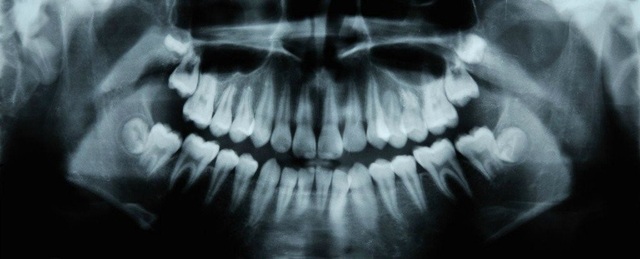 Thuốc điều trị Alzheimer giúp chữa sâu răng - 1 Thuốc điều trị Alzheimer giúp chữa sâu răng - 1