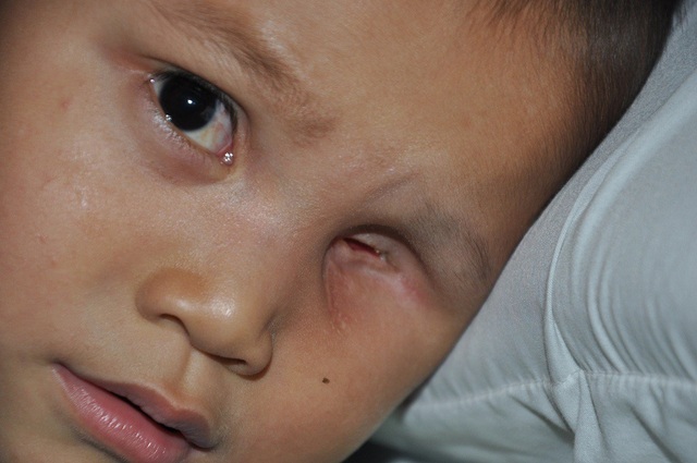 Mẹ ơi, mắt của con “trốn” đi đâu rồi? - 2 Hiện tại em đã được khoét bỏ 1 mắt và đang tiếp tục điều trị.