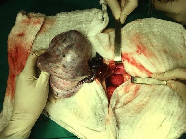 Bé 13 tuổi đau bụng dữ dội vì u nang buồng trứng hoại tử - 1 Khối u khổng lồ bị xoắn gây hoại tử khiến bệnh nhi bị đau bụng dữ dội