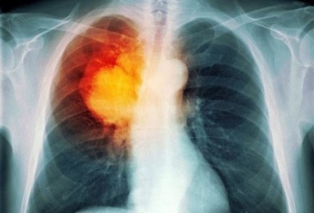 Lao phổi là căn bệnh nguy hiểm đang lưu hành trong cộng đồng