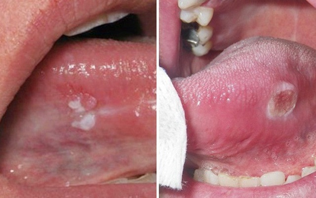 Bị nhiệt miệng đi khám mới phát hiện mắc ung thư lưỡi - 1 Ung thư lưỡi dễ nhầm lẫn với các bệnh ở miệng thông thường