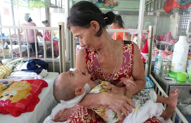 16.000 người chết vì “thờ ơ” với bệnh lao - 1 Bé trai 2 tuổi đối mặt với nhiều biến chứng nguy hiểm của bệnh lao vì không được chích ngừa