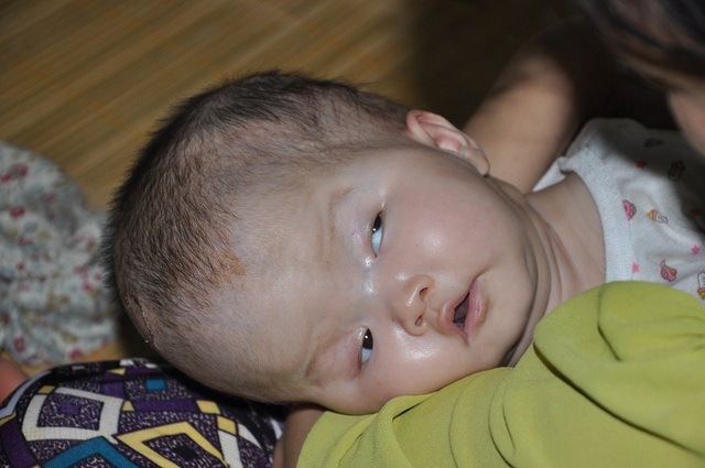 "Giá trời bắt mẹ chết đi, còn hơn sinh ra các con phải khổ như này !" - 3 Bé Lệ Thủy (4 tháng tuổi) bị não úng thủy và thoát vị màng não tủy.