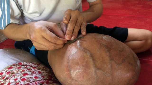 "Hàng ngày, tôi phải dùng đỉa hút máu chính mình cho... đỡ đau !" - 6 Vì quá đau nhức, anh đành dùng đỉa để hút máu để đỡ đau