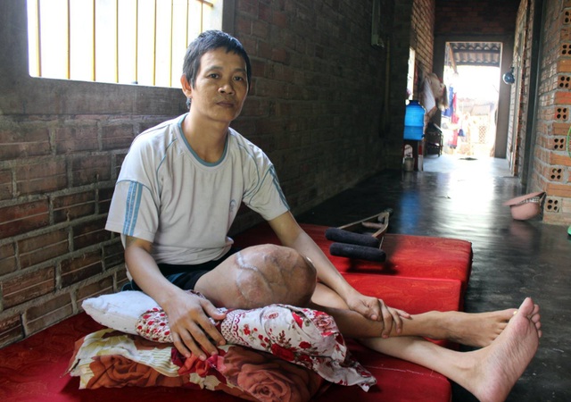 "Hàng ngày, tôi phải dùng đỉa hút máu chính mình cho... đỡ đau !" - 2
Anh Quy mang khối U bên mình đã 7 năm nhưng không có tiền chữa trị
