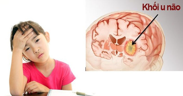 Ung thư não - Nguyên nhân tử vong hàng đầu ở các bệnh nhi và người trẻ tuổi - 1 Trẻ em cũng là đối tượng dễ mắc ung thư não