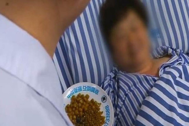 Loại bỏ thành công... 468 viên sỏi mật ra khỏi cơ thể bệnh nhân - 1 Số lượng những viên sỏi mật gắp ra từ cơ thể bệnh nhân nữ khiến nhiều người choáng váng