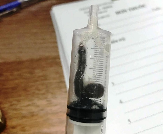 Kinh hoàng hai con vắt sống trong mũi bệnh nhân - 2 Con vắt được lấy ra dài 7cm.