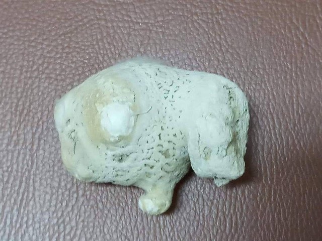 Viên sỏi “khủng” nằm trong thận của bệnh nhân bị thận móng ngựa - 1
Viên sỏi khủng nằm trong thận của anh Q.