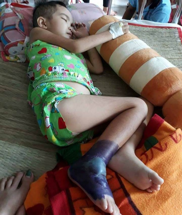 Thương bé gái người Tày vừa bị ung thư máu vừa hoại tử chân - 4 Vết cháy nhiễm trùng, sưng phồng lên hành hạ bé từng đêm