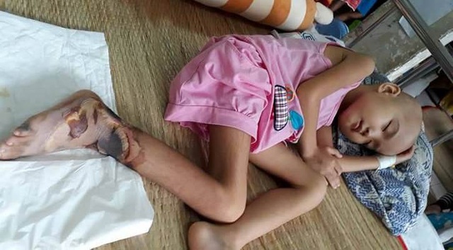 Thương bé gái người Tày vừa bị ung thư máu vừa hoại tử chân - 3 Chân của con bị cháy ven nham nhở và vì chứng ung thư máu nên khó lành, dễ nhiễm khuẩn