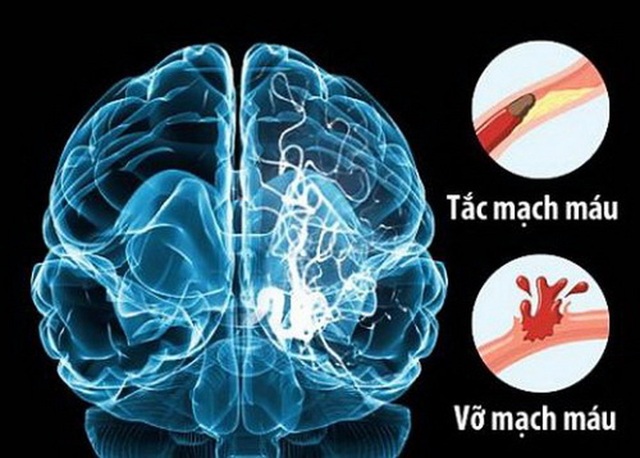 Cảnh báo: Nguy cơ đột quỵ ở người cao huyết áp mùa World cup - 3 Nguy cơ đột quỵ ở người cao huyết áp
