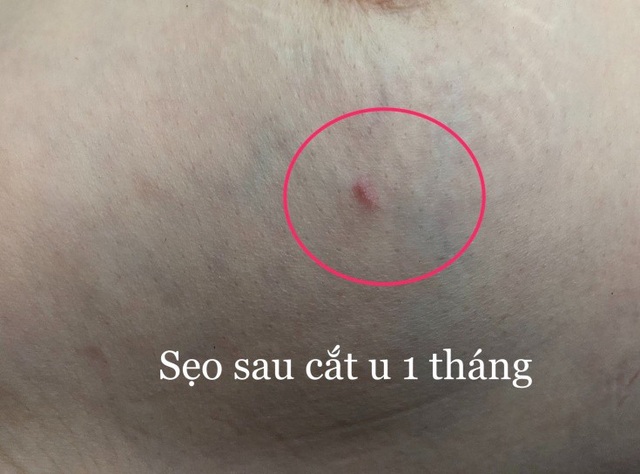 Hy vọng mới cho các chị em phải điều trị u xơ tuyến vú - 1 Hình 1. Sẹo mổ nhỏ sau cắt u bằng phương pháp sinh thiết có hỗ trợ hút chân không.