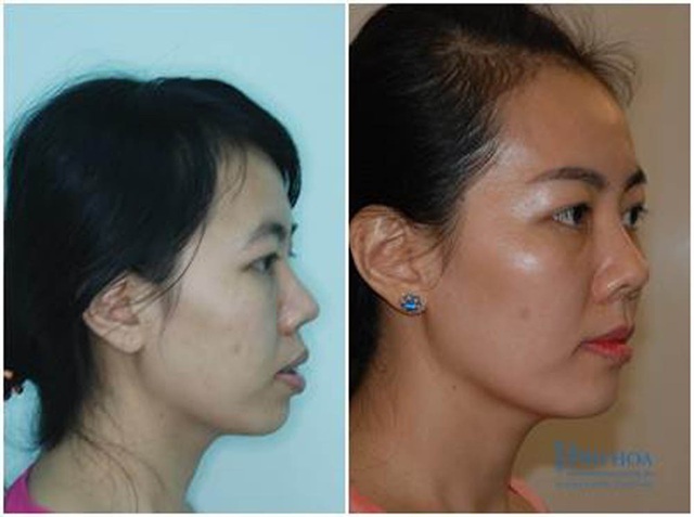 Tiến sĩ nha khoa Nguyễn Phú Hòa: Răng hô ngoài xấu còn ảnh hưởng đến sức khỏe! - 2 Tiến sĩ nha khoa Nguyễn Phú Hòa: Răng hô ngoài xấu còn ảnh hưởng đến sức khỏe! - 2