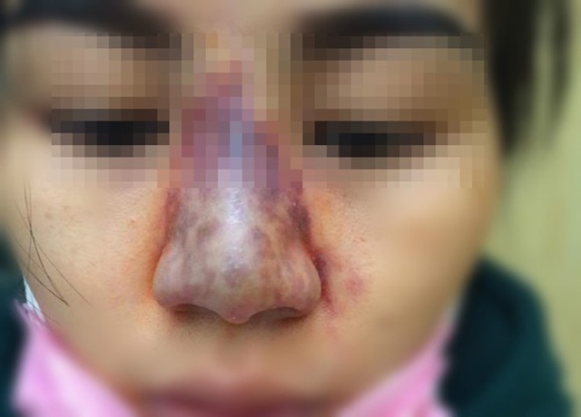 Nâng mũi làm đẹp, nữ bệnh nhân nguy cơ múc bỏ mắt | Báo Dân trí