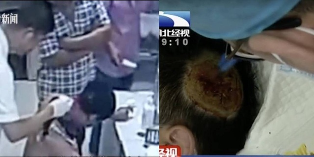 Sạc dự phòng phát nổ dưới gối khiến người đàn ông cháy rụi một phần tóc - 1 Sạc dự phòng phát nổ dưới gối khiến người đàn ông cháy rụi một phần tóc